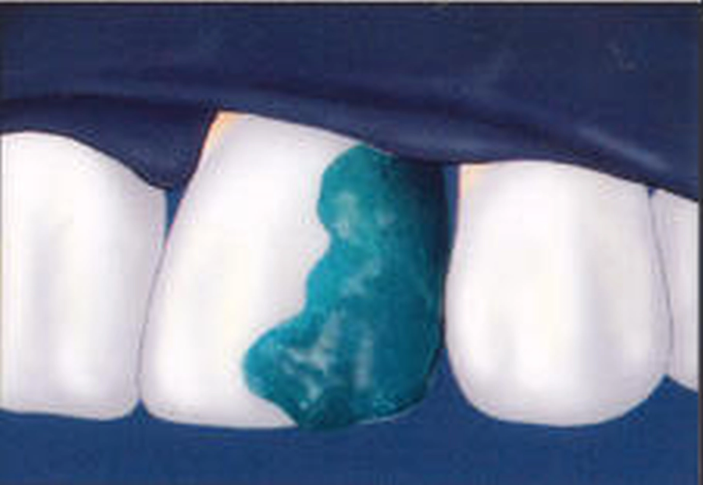 Anätzen des Zahnschmelzes